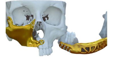 RECONSTRUÇÃO MAXILAR E MANDIBULAR - CPMH